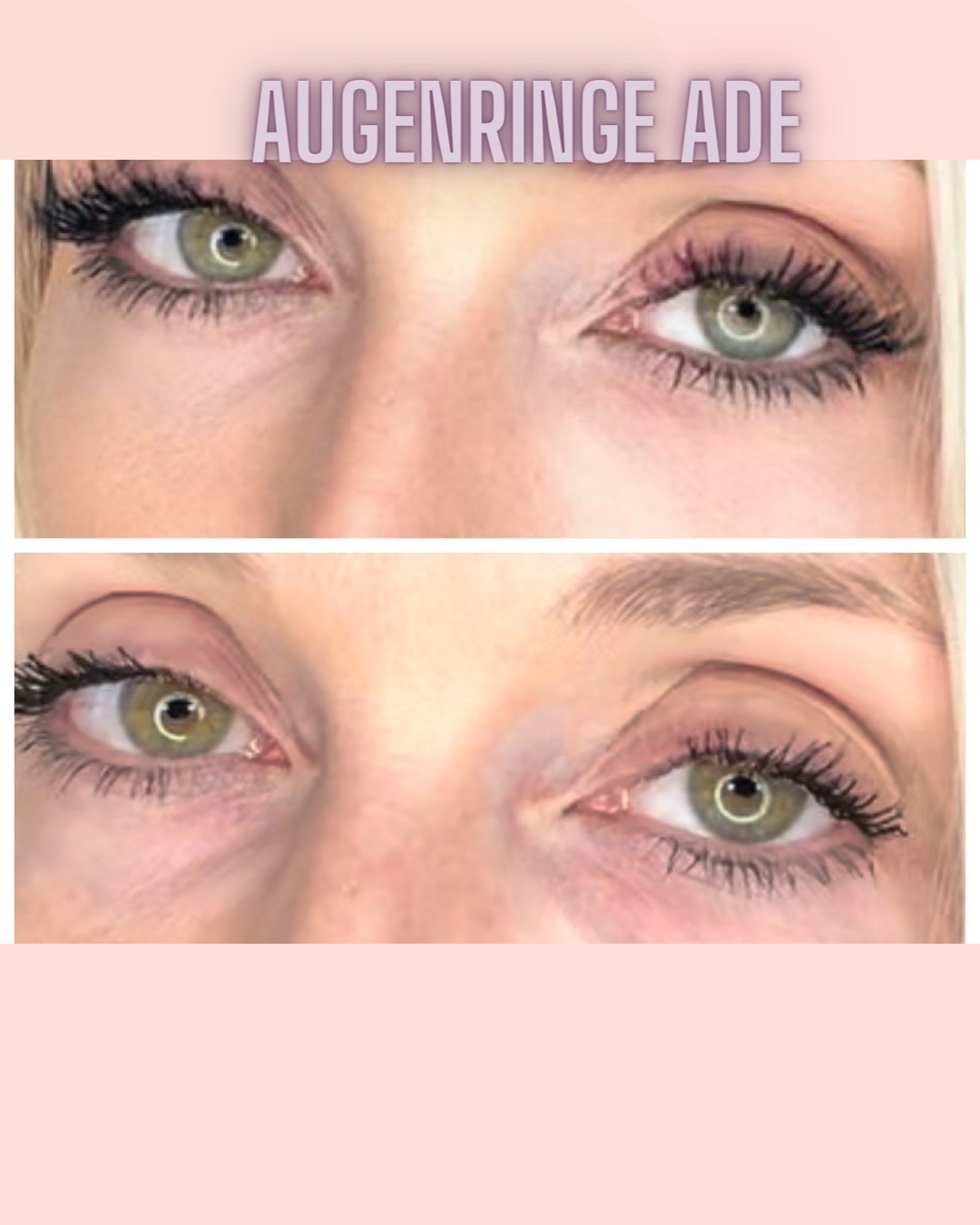 Augenringe Ade