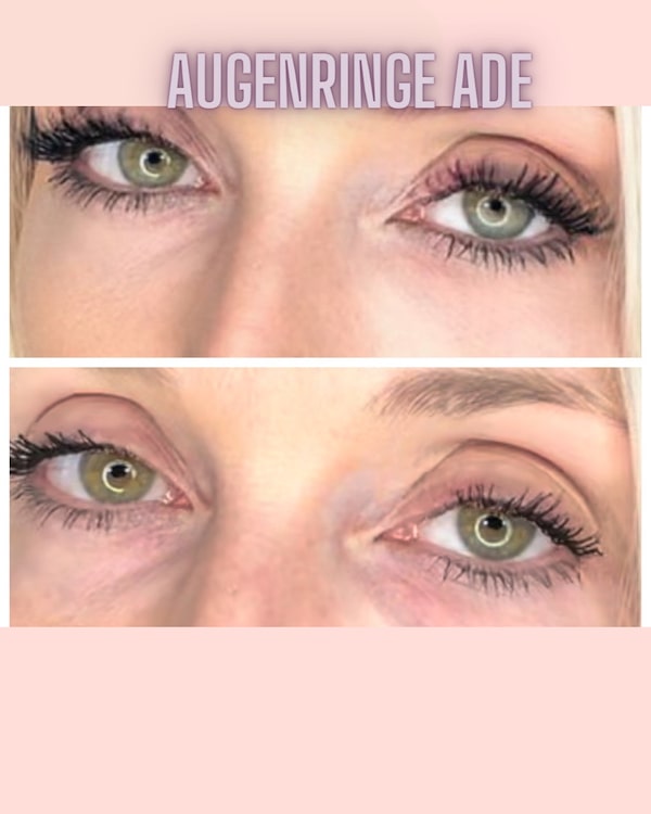 Augenringe Ade